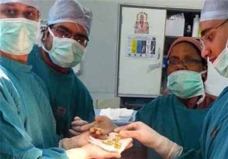 اخبار,اخبار گوناگون,بلعیدن اشیاء به دلایل مختلف