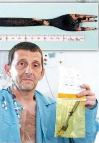 اخبار,اخبار گوناگون,بلعیدن اشیاء به دلایل مختلف