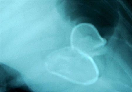 اخبار,اخبار گوناگون,بلعیدن اشیاء به دلایل مختلف