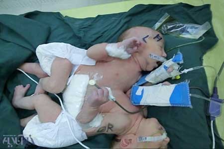 اخبار,اخبار اجتماعی , نوزادان دو قلو به هم چسبیده 