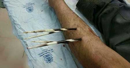 حمله جوجه‌تیغی به کشاورز لرستانی (+عکس) 1