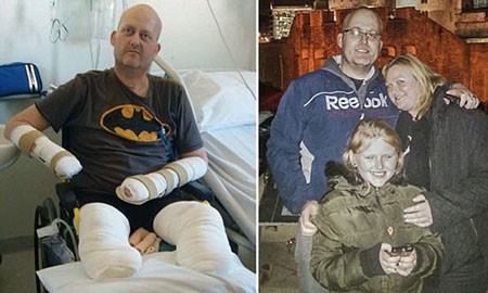 اخبار,اخبار گوناگون, باکتری‌ گوشتخوار مرد را تکه‎ تکه کرد