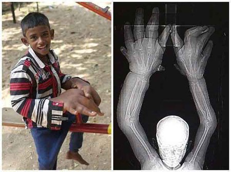 اخبار , اخبار گوناگون , بیماری عجیب 