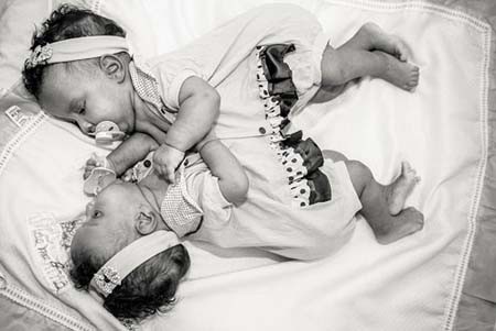 اخبار , اخبار گوناگون,دوقلوهای به هم چسبیده,تصاویر دوقلوهای به هم چسبیده