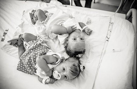 اخبار , اخبار گوناگون,دوقلوهای به هم چسبیده,تصاویر دوقلوهای به هم چسبیده