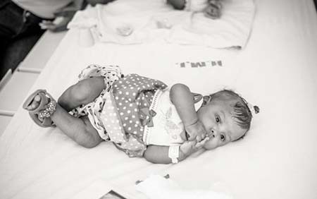 اخبار , اخبار گوناگون,دوقلوهای به هم چسبیده,تصاویر دوقلوهای به هم چسبیده