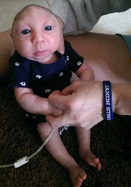 اخبار , اخبار گوناگون, نوزاد بدون مغز