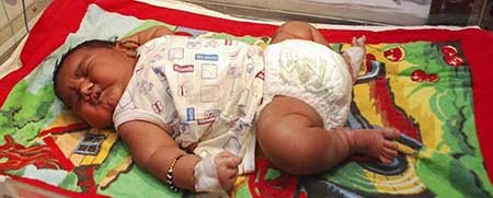 بُزرگ‌ترین نوزاد تاریخ هِند با وزن ۶.۷ کیلوگرم متولد شُد! 1