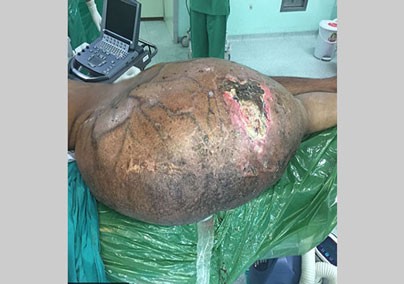 اخبار,اخبار گوناگون , تومور