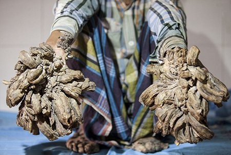 عکس/ بیماری وحشتناک مرد درختی (+13)