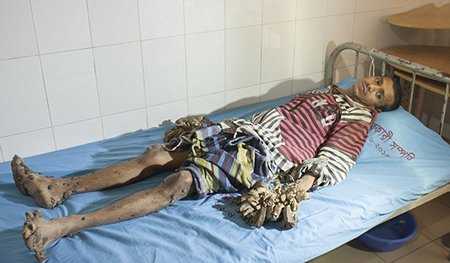 عکس/ بیماری وحشتناک مرد درختی (+13)