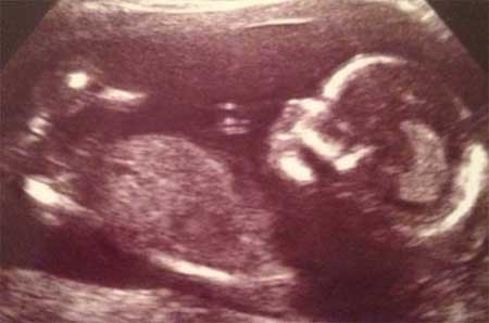 اخبار , اخبار گوناگون , بارداریهای عجیب