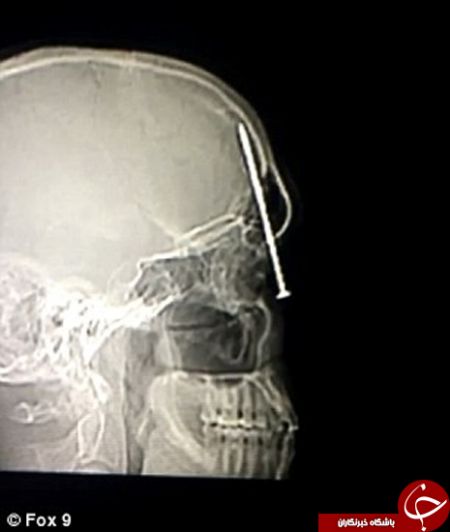 اخبارگوناگون,خبرهای گوناگون,ماجرای عجیب میخ