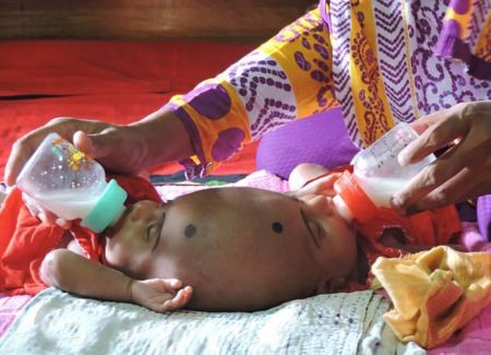 اخبار,اخبار گوناگون,دوقلوی عجیب الخلقه