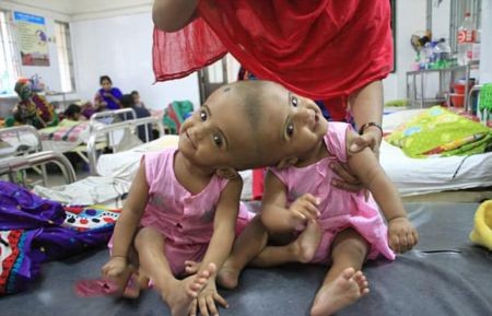 اخبار,اخبار گوناگون,دوقلوی عجیب الخلقه