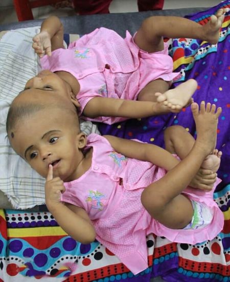 اخبار,اخبار گوناگون,دوقلوی عجیب الخلقه