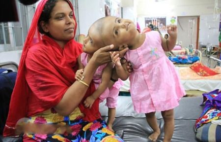 اخبار,اخبار گوناگون,دوقلوی عجیب الخلقه