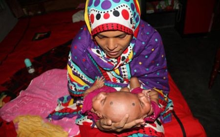 اخبار,اخبار گوناگون,دوقلوی عجیب الخلقه