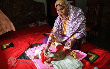 اخبار,اخبار گوناگون,دوقلوی عجیب الخلقه