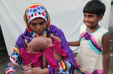 اخبار,اخبار گوناگون,دوقلوی عجیب الخلقه