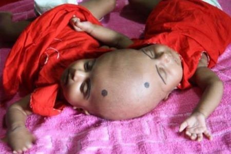 اخبار,اخبار گوناگون,دوقلوی عجیب الخلقه