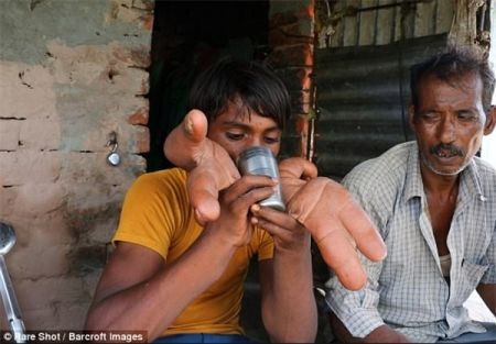 اخبار,اخبار گوناگون,دستان عجیب نوجوان هندی اخبار,اخبار گوناگون,دستان عجیب نوجوان هندی