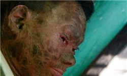 اخبار,اخبار گوناگون,بیماری عجیب دختر16ساله هندی