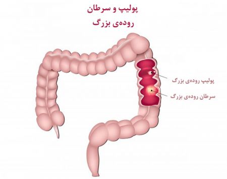   اخبارپزشکی ,خبرهای  پزشکی  ,سرطان روده