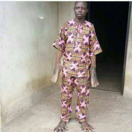 اخبار,اخبار گوناگون, مردی که جای دست و پایش جابجا شده است