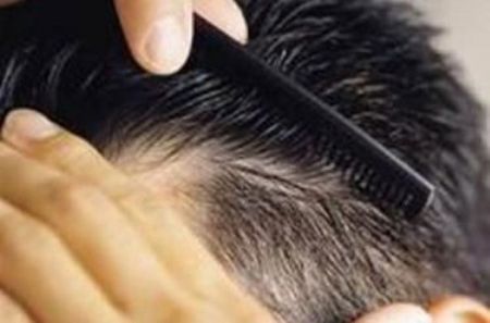 اخبارپزشکی,خبرهای پزشکی, درمان ریزش مو اخبارپزشکی,خبرهای پزشکی, درمان ریزش مو