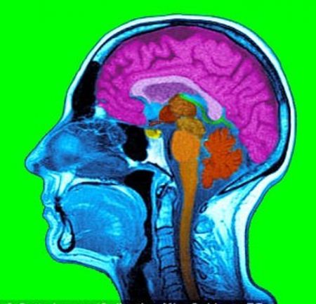 اخبارپزشکی,خبرهای پزشکی, سکته مغزی اخبارپزشکی,خبرهای پزشکی, سکته مغزی
