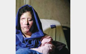 سهیلا جورکش:3سال از درد و عذاب اسیدپاشی به صورتم می گذرداما هنوز کسی دستگیر نشده