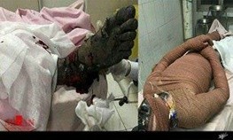 اخبارحوادث ,خبرهای حوادث, سوختگی اخبارحوادث ,خبرهای حوادث, سوختگی