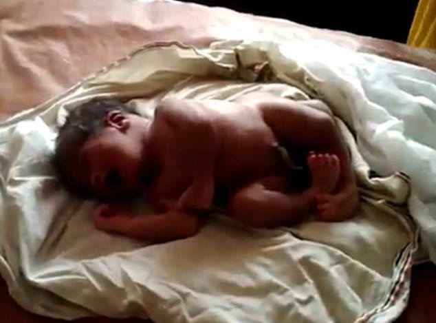 اخبار,اخبارگوناگون, تولد نوزادی با ۴ پا در هند
