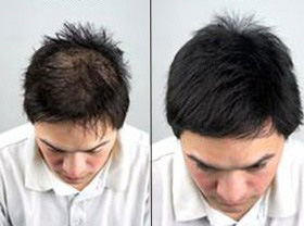 مزوتراپی مو,مزوتراپی موی سر مزوتراپی مو,مزوتراپی موی سر
