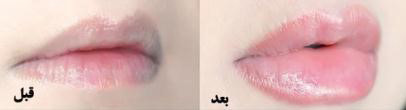 پروتزلب,حجم دهنده لب,تزریق ژل لب پروتزلب,حجم دهنده لب,تزریق ژل لب