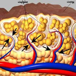 سلولیت(تجمع چربی) 1