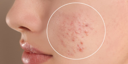 رفع آکنه با غذا