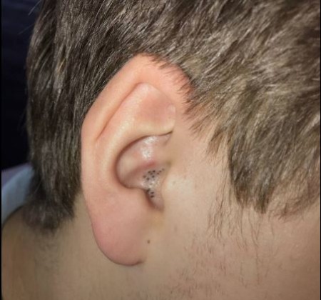 درمان جوش‌های سر سیاه در گوش