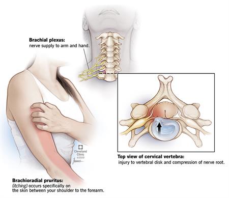 عضله بازویی زبرزندی, خارش براکیورادیال چیست, درمان عارضه براکیورادیال