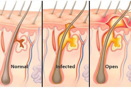 جوش چرکی روی باسن, جوش روی باسن نشانه چیست, رفع جوش روی باسن