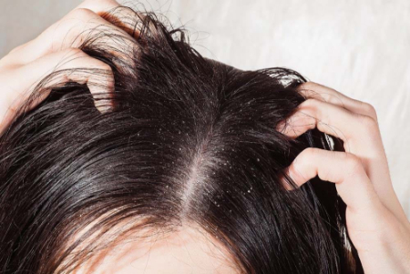 راهکارهای جلوگیری از شوره سر