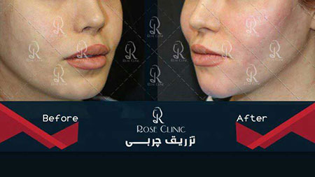 تزریق چربی کاشت مو,کلینیک پوست و مو,تزریق چربی