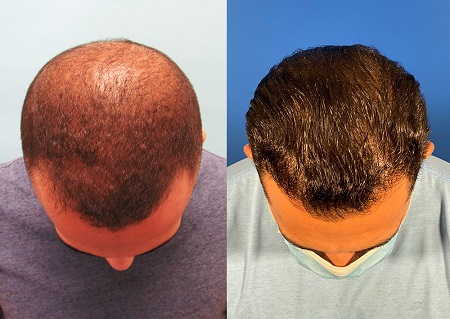 عکس کاشت مو ترکیبی, کاشت مو طبیعی, مراحل کاشت مو ترکیبی