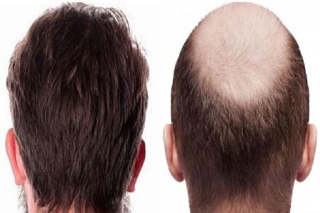 کاشت مو کاشت مو,هزینه کاشت مو,کاشت موی تضمینی