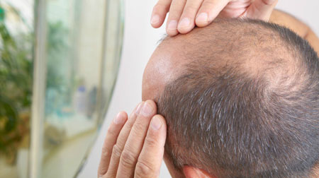 عکس محصول درمان قطعی ریزش مو چگونه ممکن است؟