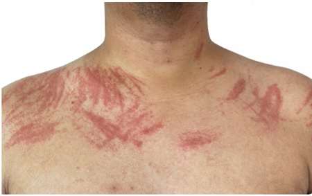 روش تشخیص درماتوگرافی, درماتوگرافیسم, درماتوگرافی