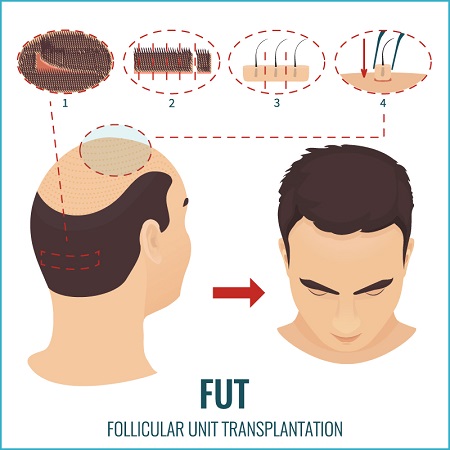 عوارض کاشت مو به روش FUT, روش های کاشت مو, کاشت مو به روش FUT