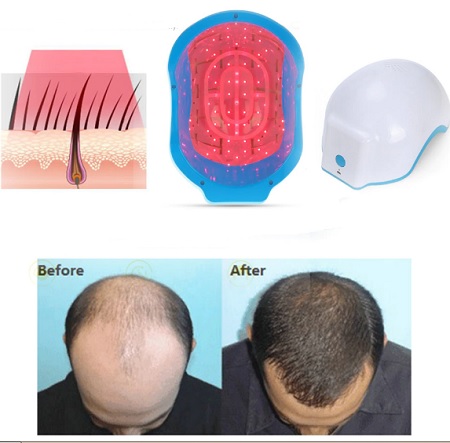  لیزرتراپی مو, درمان ریزش مو با لیزر, دستگاه لیزر تراپی مو