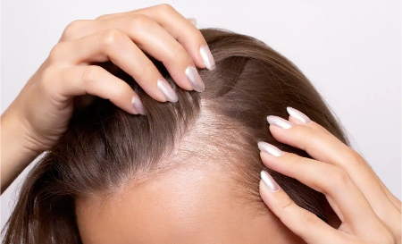 درمان خانگی ریزش مو
